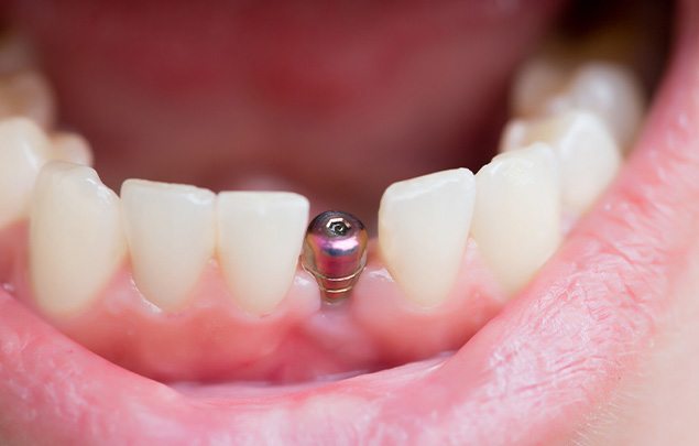 Closeup of dental implant post in someone’s lower arch