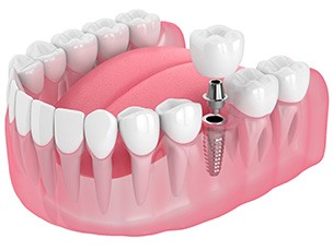 Illustration of a single dental implant