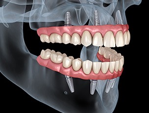 A 3D illustration of complete All-on-4 Dentures