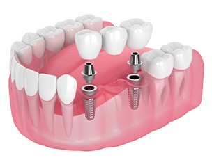 Illustration of an implant bridge