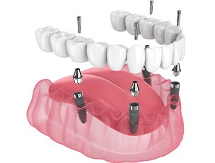 Illustration of an implant denture