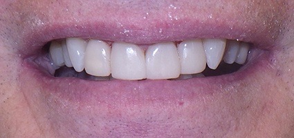 Perfect smile after dental bonding
