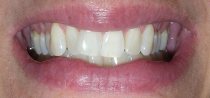 Crooked teeth before alignment