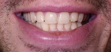 case 11 after