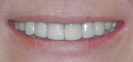 Dental crowns repairing worn front teeth