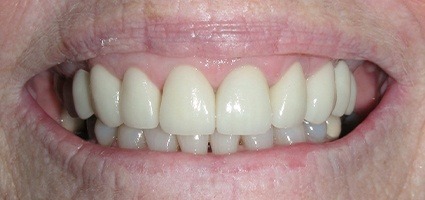 Beautiful smile after gingival recontouring