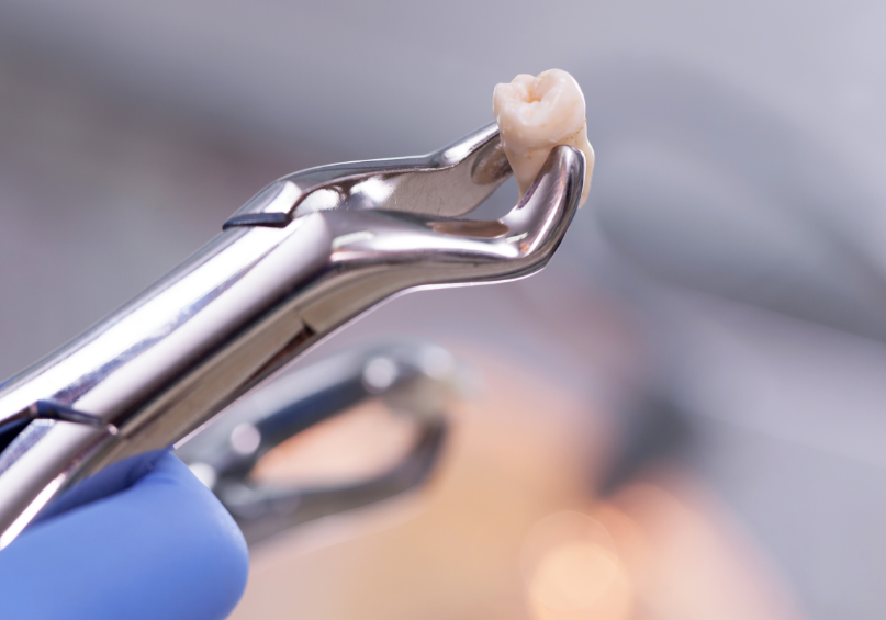 Extracted tooth on forceps