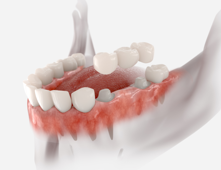 3D image of a mouth and a dental bridge